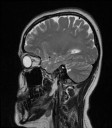 Sagittal Slice 1