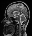 Sagittal Slice 6