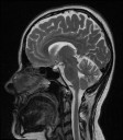 Sagittal Slice 5